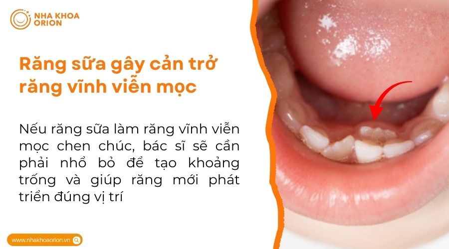 Răng sữa g&acirc;y cản trở răng vĩnh viễn mọc