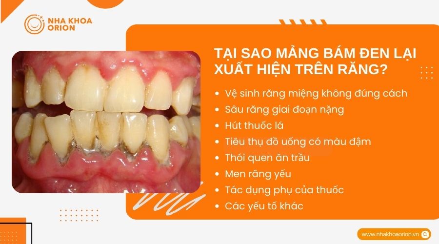 Tại sao mảng b&aacute;m đen lại xuất hiện tr&ecirc;n răng?