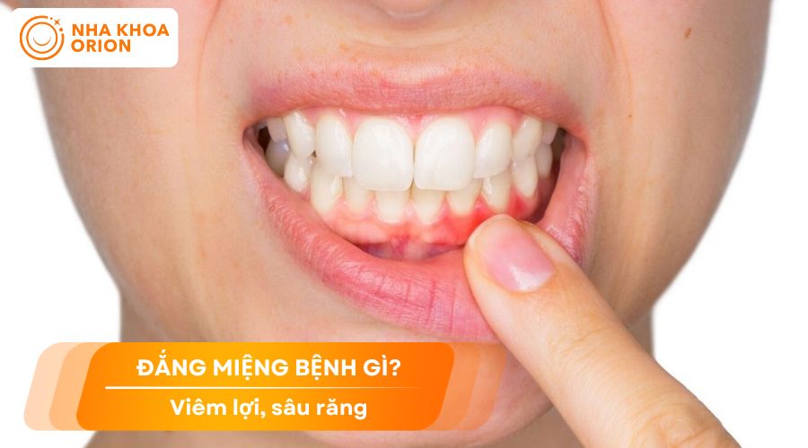 Bệnh vi&ecirc;m lợi, s&acirc;u răng l&agrave;m cho miệng bị đắng
