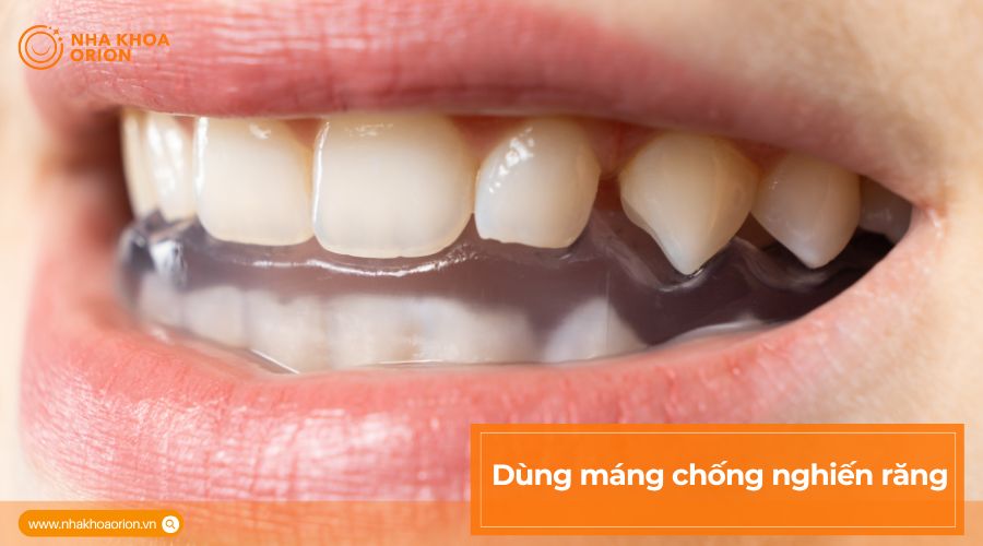 Dùng m&aacute;ng chống nghiến răng