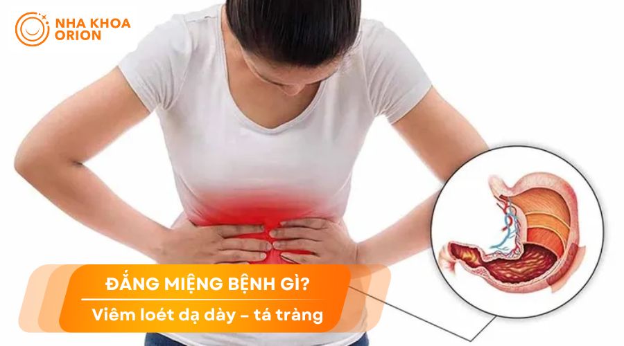 Ngủ dậy miệng đắng c&oacute; thể do bệnh vi&ecirc;m lo&eacute;t dạ d&agrave;y t&aacute; tr&agrave;ng