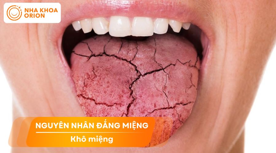 Ngủ dậy miệng đắng do kh&ocirc; miệng