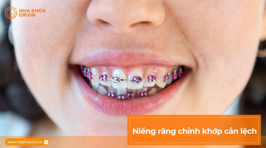 Niềng răng chỉnh khớp cắn lệch