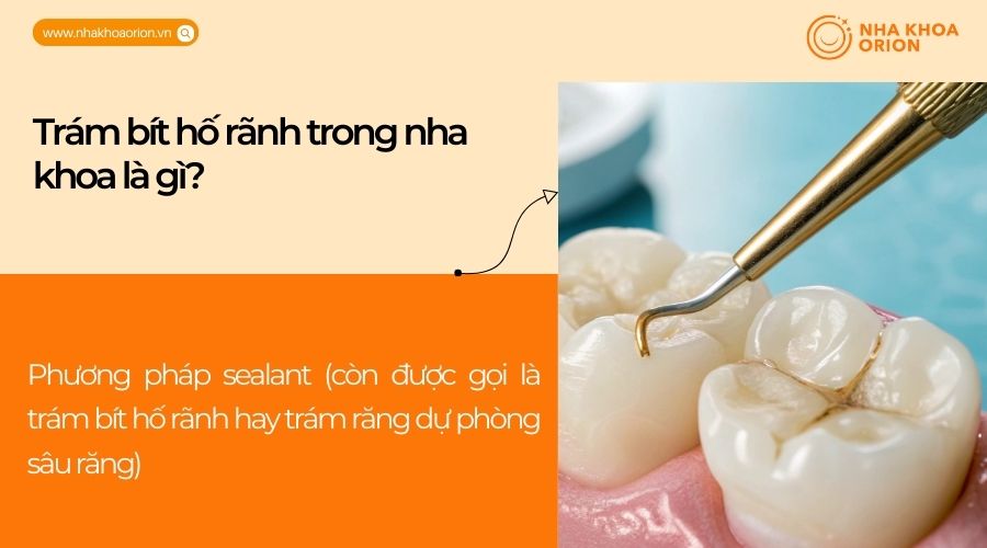 Tr&aacute;m b&iacute;t hố r&atilde;nh trong nha khoa l&agrave; g&igrave;?
