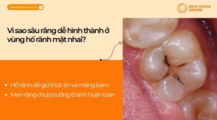 V&igrave; sao s&acirc;u răng dễ h&igrave;nh th&agrave;nh ở v&ugrave;ng hố r&atilde;nh mặt nhai?