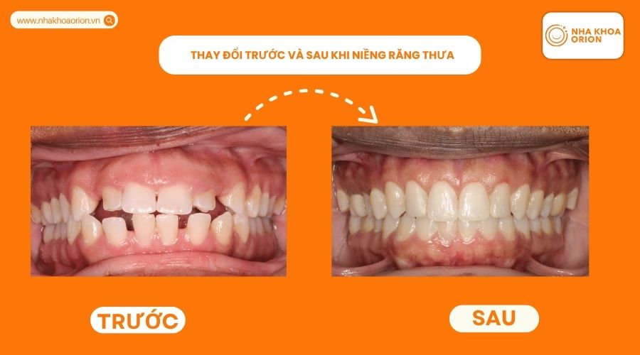 Thay đổi trước v&agrave; sau khi niềng răng thưa