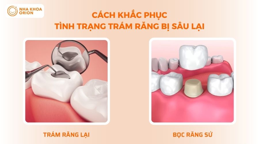 Phương ph&aacute;p khắc phục khi răng tr&aacute;m bị s&acirc;u lại