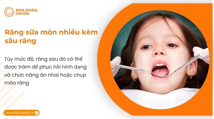 Răng sữa m&ograve;n nhiều k&egrave;m s&acirc;u răng