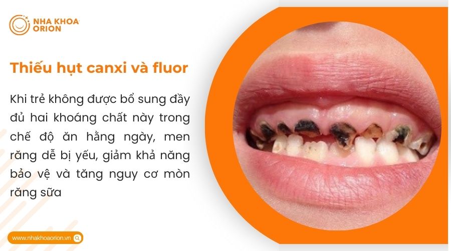 Thiếu hụt canxi v&agrave; fluor ở trẻ d&ecirc;̃ d&acirc;̃n đ&ecirc;́n men răng bị y&ecirc;́u