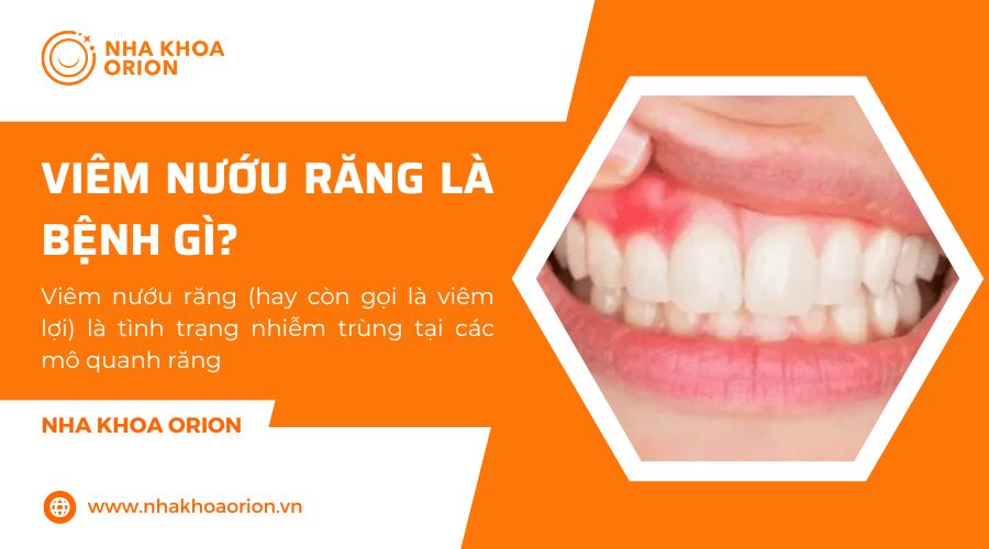 Bệnh vi&ecirc;m nướu răng l&agrave; g&igrave;