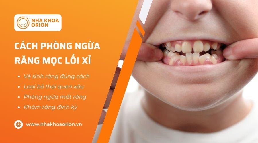 C&aacute;ch ph&ograve;ng ngừa răng lồi xỉ