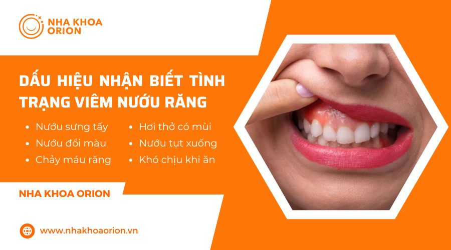 Dấu hiệu nhận biết vi&ecirc;m nướu răng