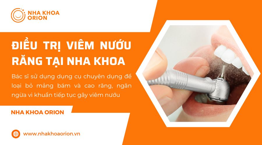 Điều trị vi&ecirc;m nướu răng an to&agrave;n, hiệu quả tại Nha Khoa Orion