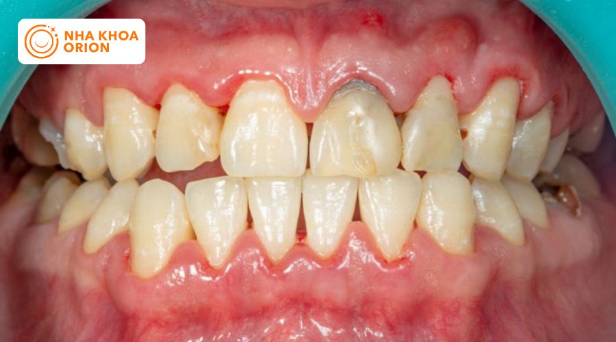 Vi&ecirc;m nướu răng đ&atilde; trở n&ecirc;n nghi&ecirc;m trọng