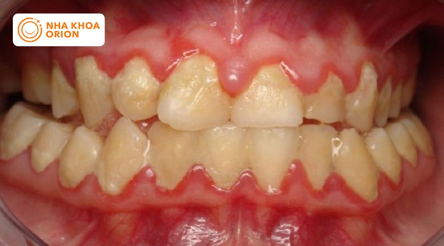 M&ocirc; nướu quanh ch&acirc;n răng bị sưng to v&agrave; chuyển sang m&agrave;u đỏ