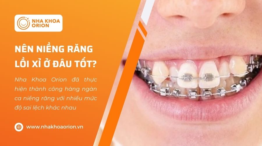 Niềng răng lồi xỉ an to&agrave;n, hiệu quả tại Nha khoa Orion