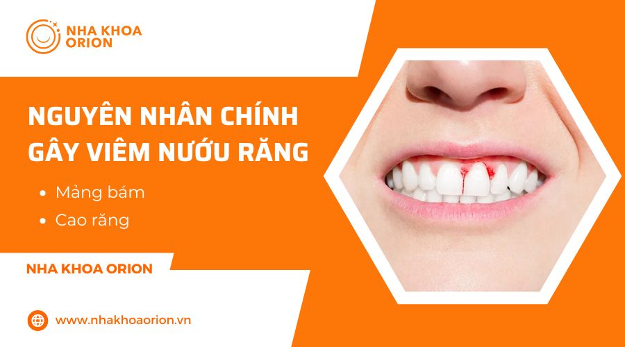 Nguy&ecirc;n nh&acirc;n phổ biến g&acirc;y vi&ecirc;m nướu răng l&agrave; mảng b&aacute;m v&agrave; cao răng