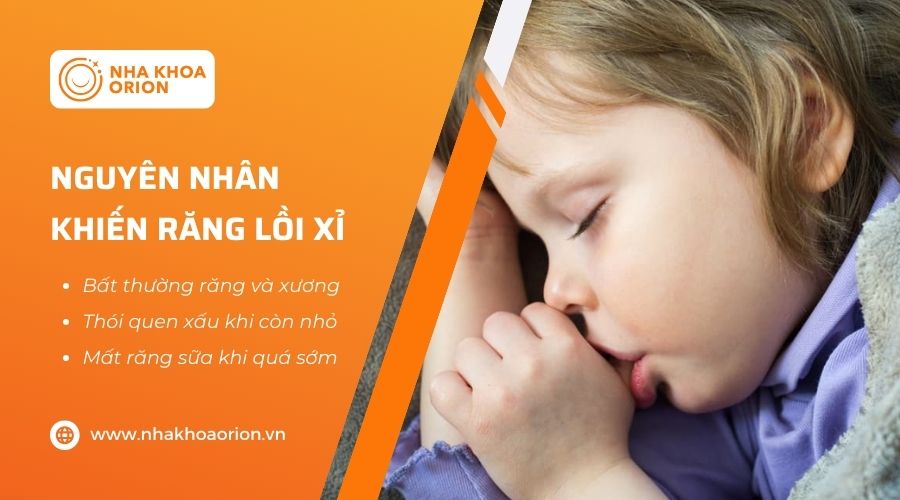C&oacute; nhiều nguy&ecirc;n nh&acirc;n khiến răng lồi xỉ