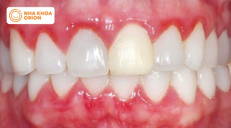 Nướu răng bị vi&ecirc;m nhẹ g&acirc;y sưng đỏ