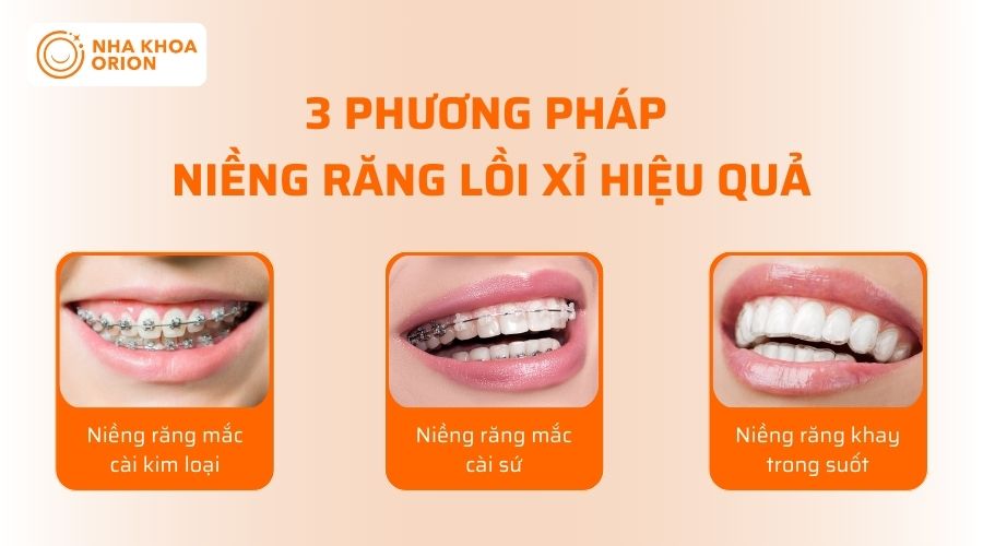 3 phương ph&aacute;p niềng răng lồi xỉ hiệu quả hiện nay