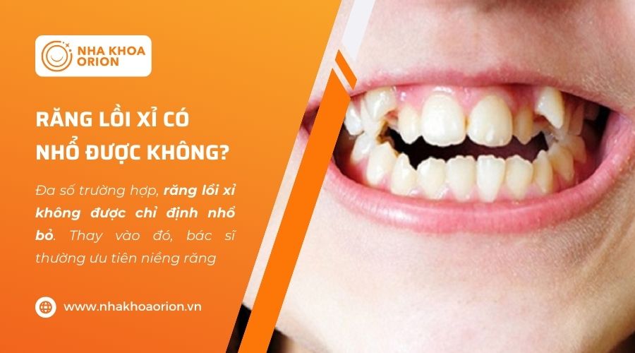 Răng lồi xỉ chỉ được chỉ định nhổ trong một số trường hợp nhất định