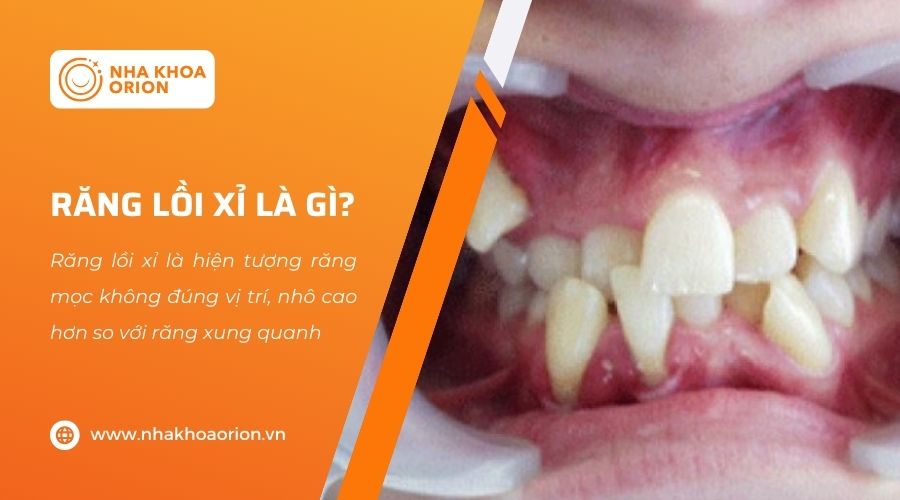 T&igrave;m hiểu về răng lồi xỉ l&agrave; g&igrave;