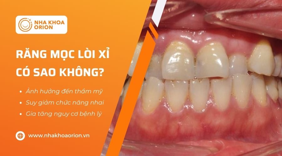 Răng mọc lồi xỉ kh&ocirc;ng trực tiếp g&acirc;y hại đến sức khỏe