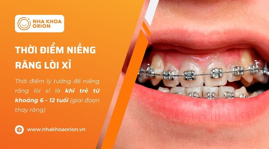 Thời điểm niềng răng lồi xỉ tốt nhất