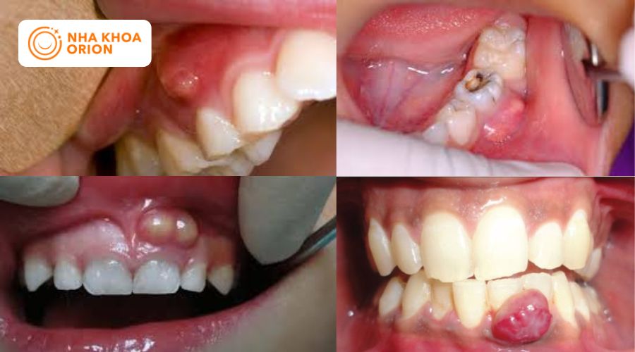 Vi&ecirc;m nướu răng c&oacute; mủ, ổ dịch trong khoang miệng