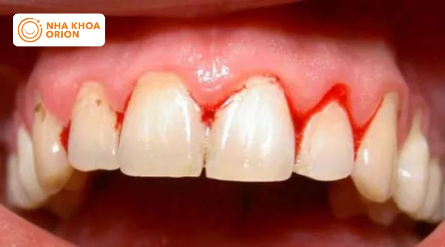Vi&ecirc;m nướu răng khiến ch&acirc;n răng dễ bị chảy m&aacute;u