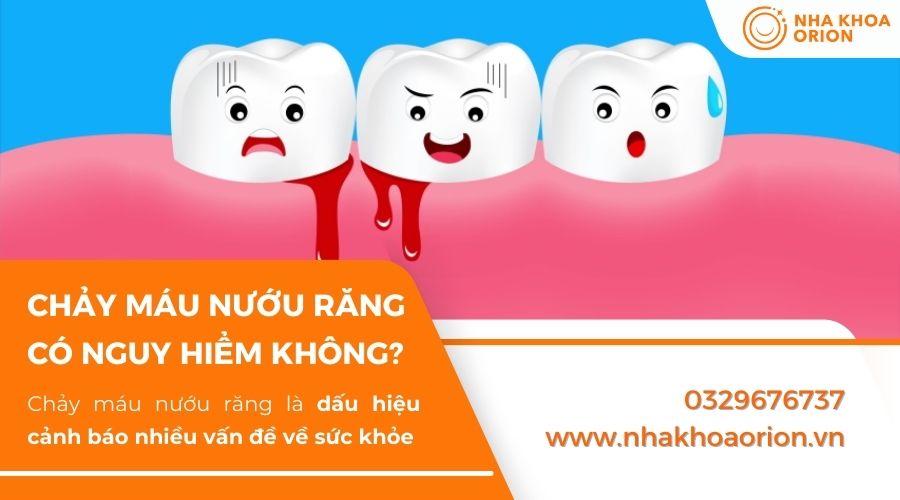 Chảy m&aacute;u nướu răng c&oacute; thể g&acirc;y nguy hiểm cho sức khỏe