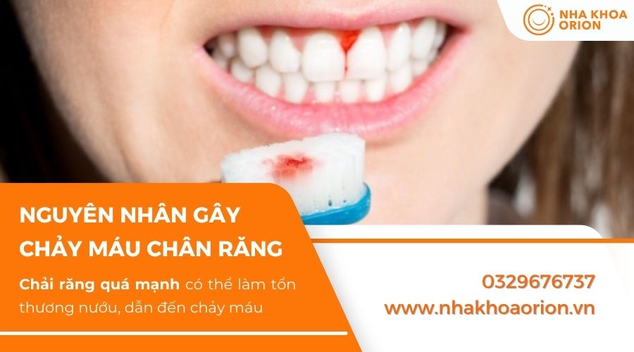 Chảy m&aacute;u nướu răng do chải răng qu&aacute; mạnh