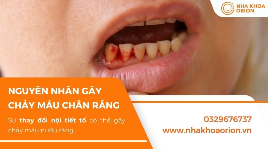 Chảy m&aacute;u nướu răng do thay đổi nội tiết tố
