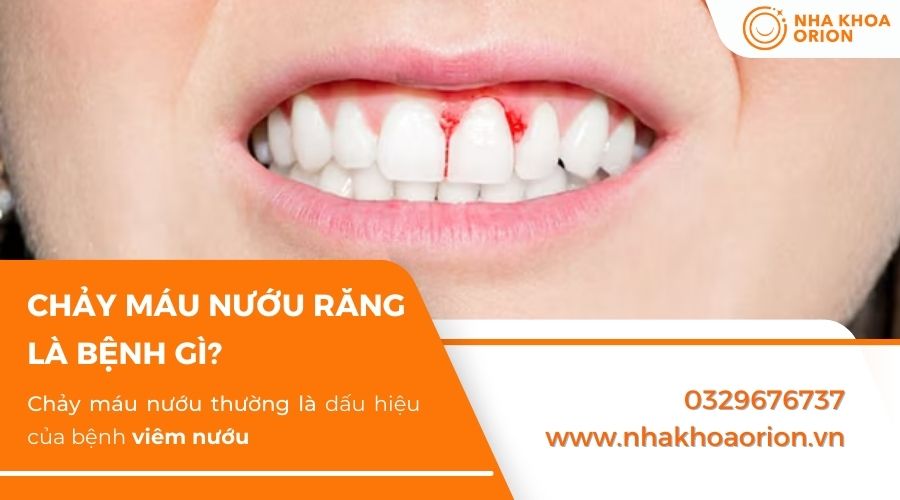 Chảy m&aacute;u do vi&ecirc;m nướu răng l&agrave; t&igrave;nh trạng nhiều người gặp phải nhất