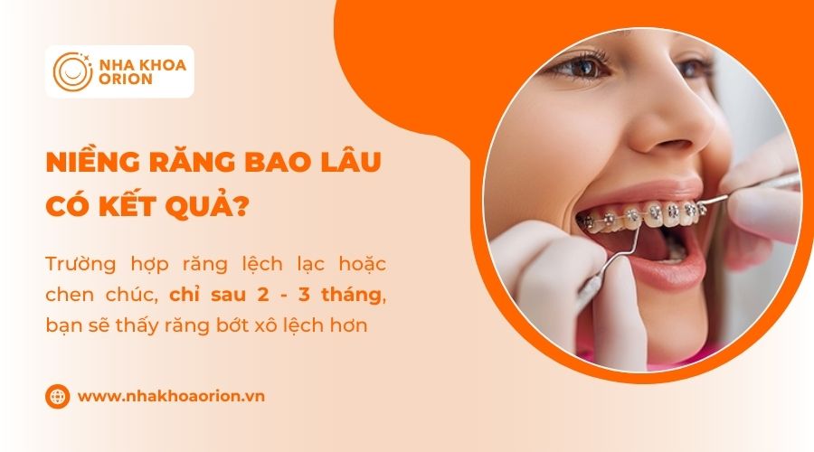 Niềng răng cần thời gian &iacute;t nhất 2 - 3 th&aacute;ng để thấy kết quả