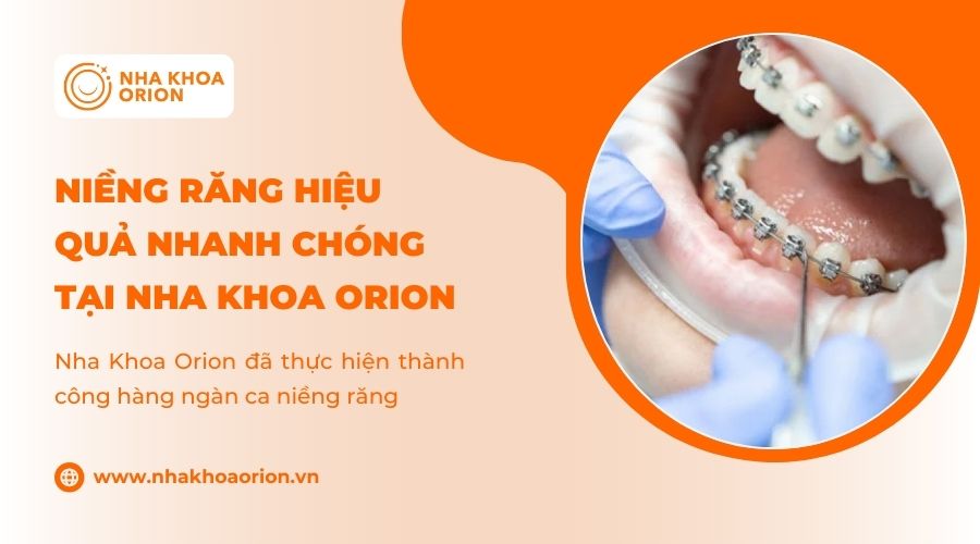 Niềng răng hiệu quả với mức gi&aacute; ưu đ&atilde;i tại Nha khoa Orion