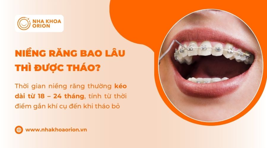 T&igrave;m hiểu niềng răng bao l&acirc;u th&igrave; được th&aacute;o