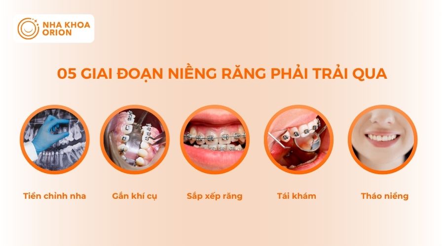 5 giai đoạn niềng răng cơ bản