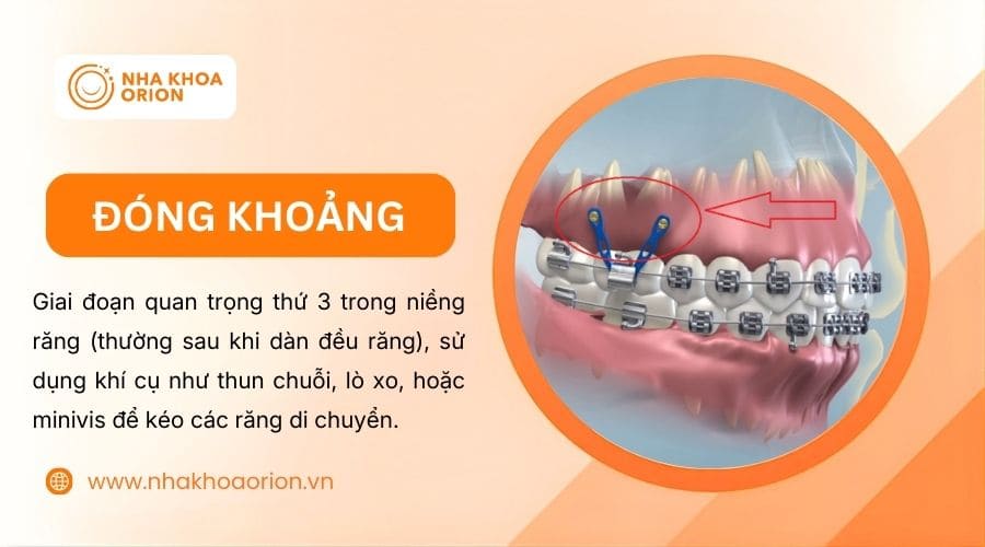 Giai đoạn đ&oacute;ng khoảng răng gi&uacute;p k&eacute;o răng di chuyển v&agrave; kh&iacute;t nhau