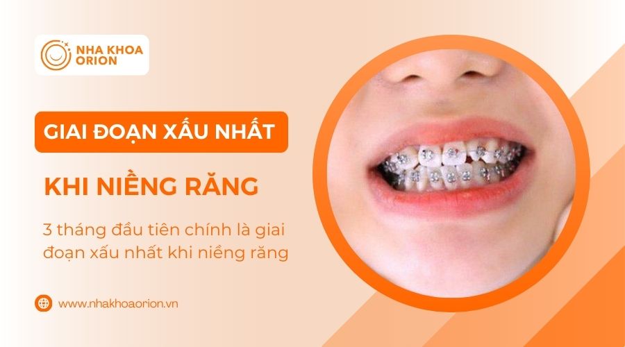 Giai đoạn xấu nhất khi niềng răng l&agrave; l&uacute;c n&agrave;o