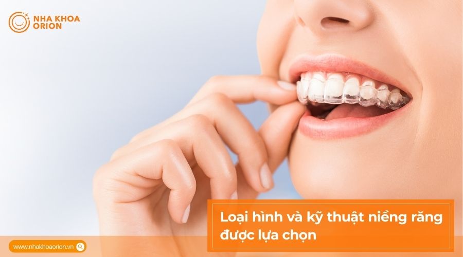 Loại h&igrave;nh v&agrave; kỹ thuật niềng răng được lựa chọn