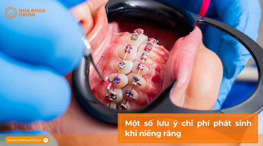 Một số lưu &yacute; chi ph&iacute; ph&aacute;t sinh khi niềng răng