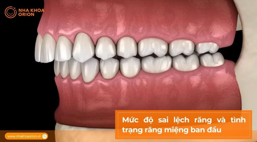 T&igrave;nh trạng răng miệng ban đầu