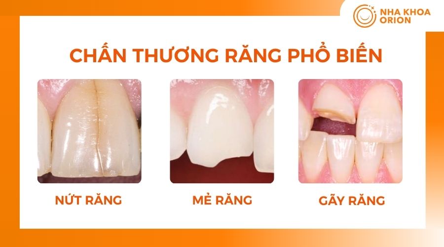 3 loại chấn thương răng phổ biến