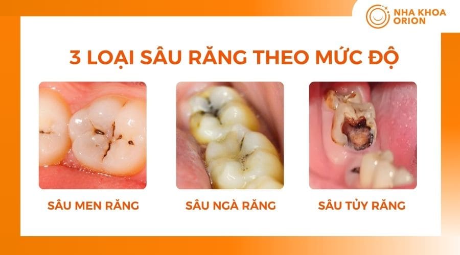 Các loại sâu răng phổ biến theo mức độ