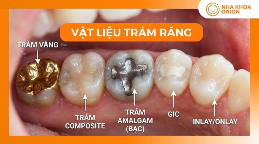 Các loại vật liệu trám răng phổ biến hiện nay