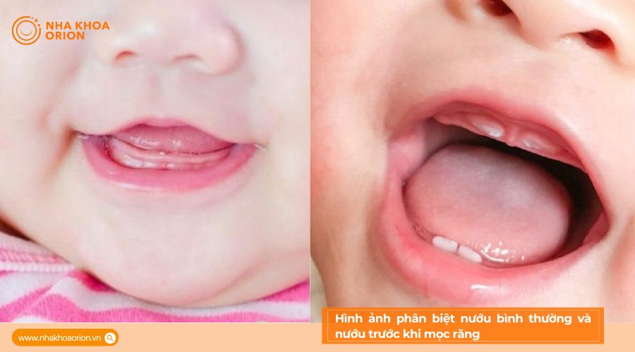 H&igrave;nh ảnh ph&acirc;n biệt nướu b&igrave;nh thường v&agrave; nướu trước khi mọc răng