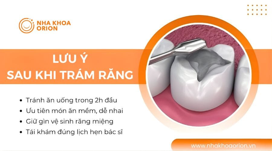 Lưu ý ai cũng cần biết sau khi trám răng