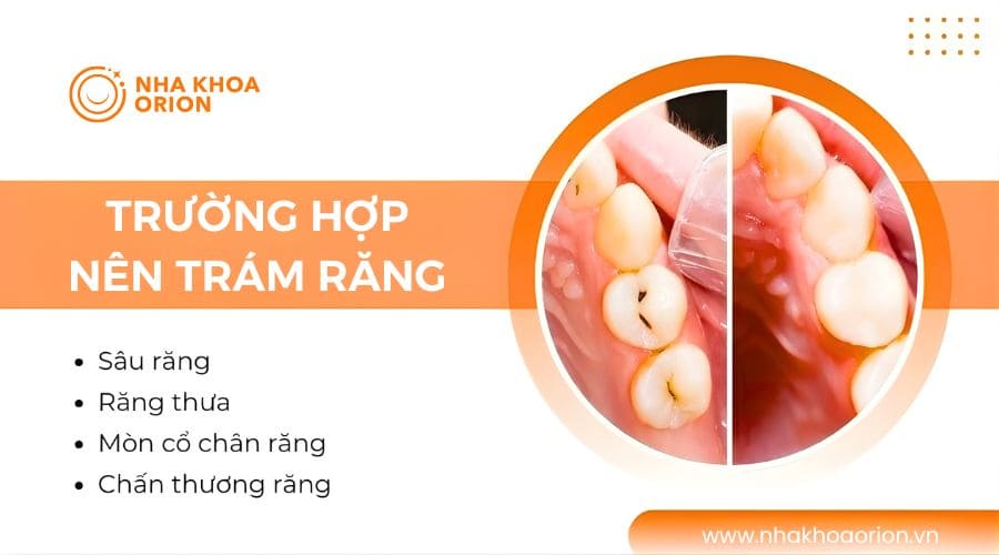 Những trường hợp nên trám răng càng sớm càng tốt