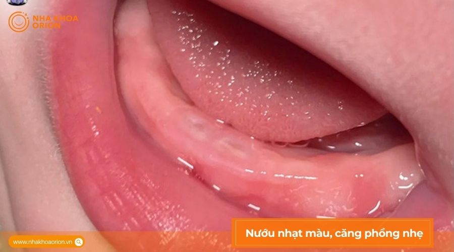 H&igrave;nh ảnh lợi trẻ sắp mọc răng